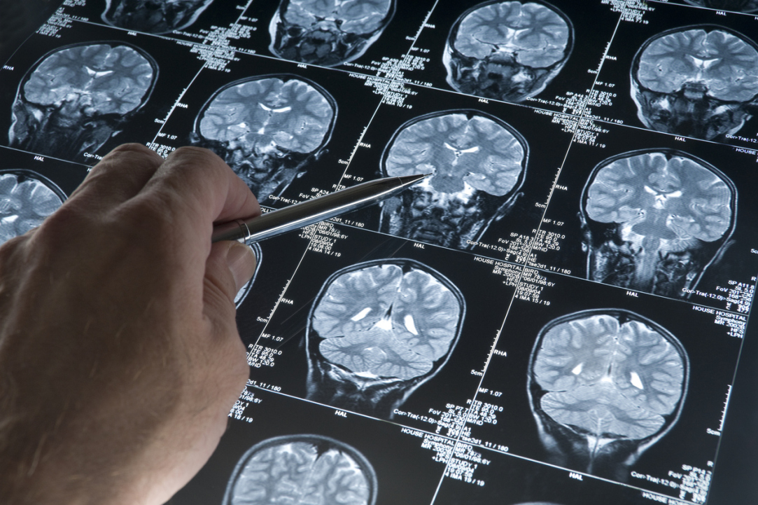 Иллюстрация к новости: Стимуляция гематоэнцефалического барьера поможет в лечении болезни Альцгеймера